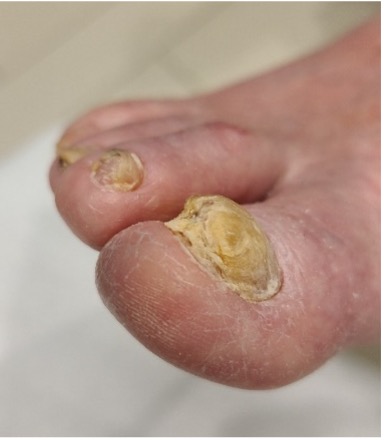 Pedi-care medische pedicure aan huis